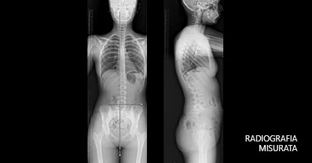 radiografia misurata rieducazione posturale scoliosi verona