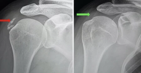 trattamento onde urto calcificazione fisioterapia tasson verona stadio